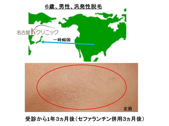 円形脱毛症　病院